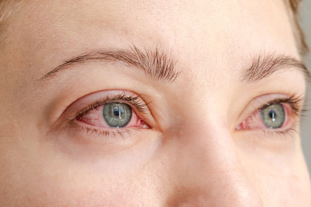 bloodshot eyes