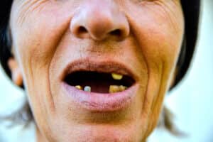 dental problems