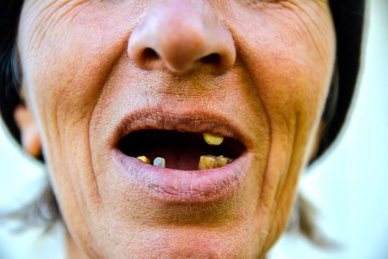 What Drugs Make Your Teeth Fall Out?